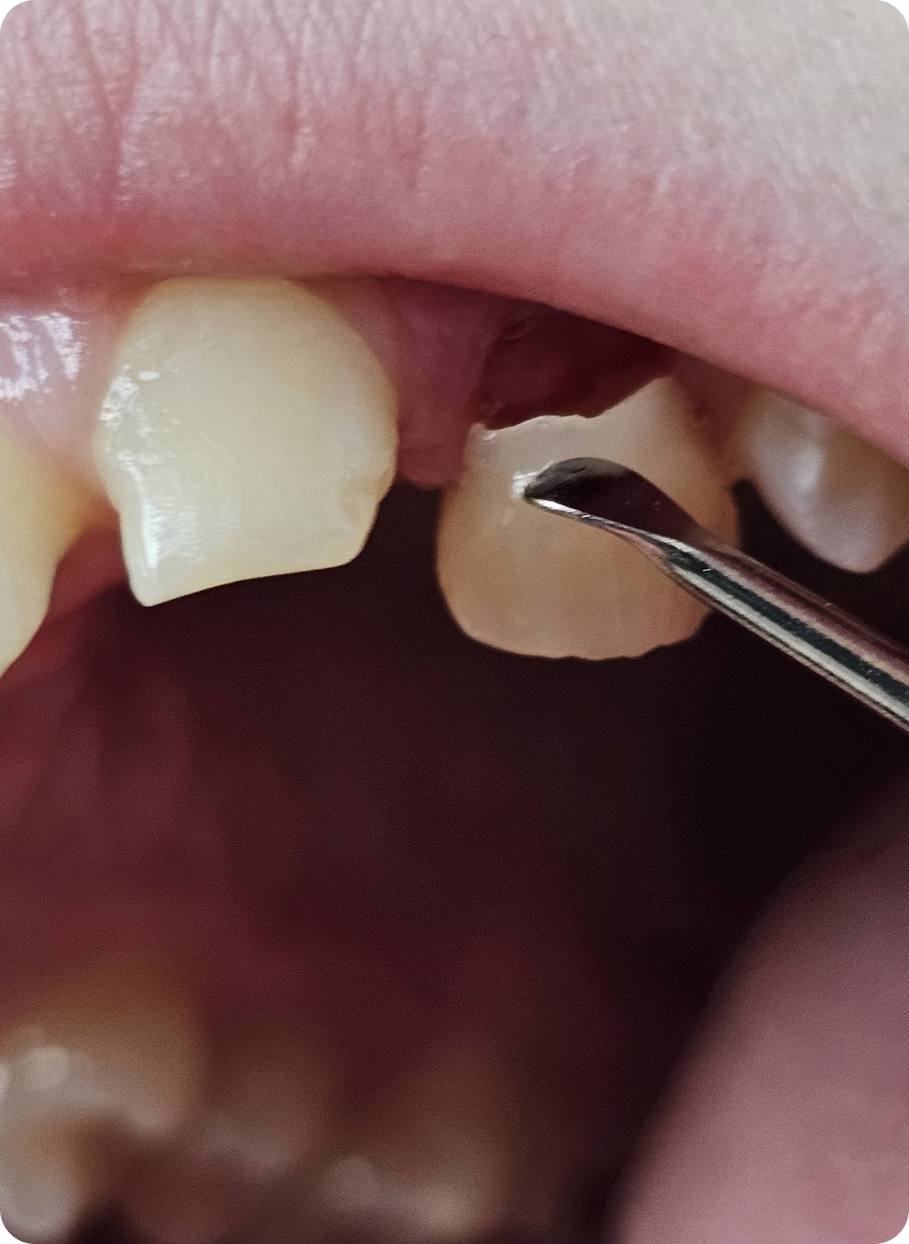 Chipped or broken tooth: when to see a dentist | Aspen Dental