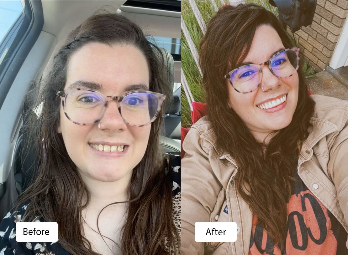 Before (left) and after (right) self portrait of woman without and with dentures