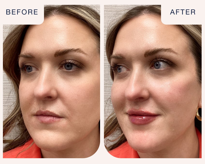 Lip and cheek filler before and after showing lifted contours, added volume, and balanced facial structure at Chapter.