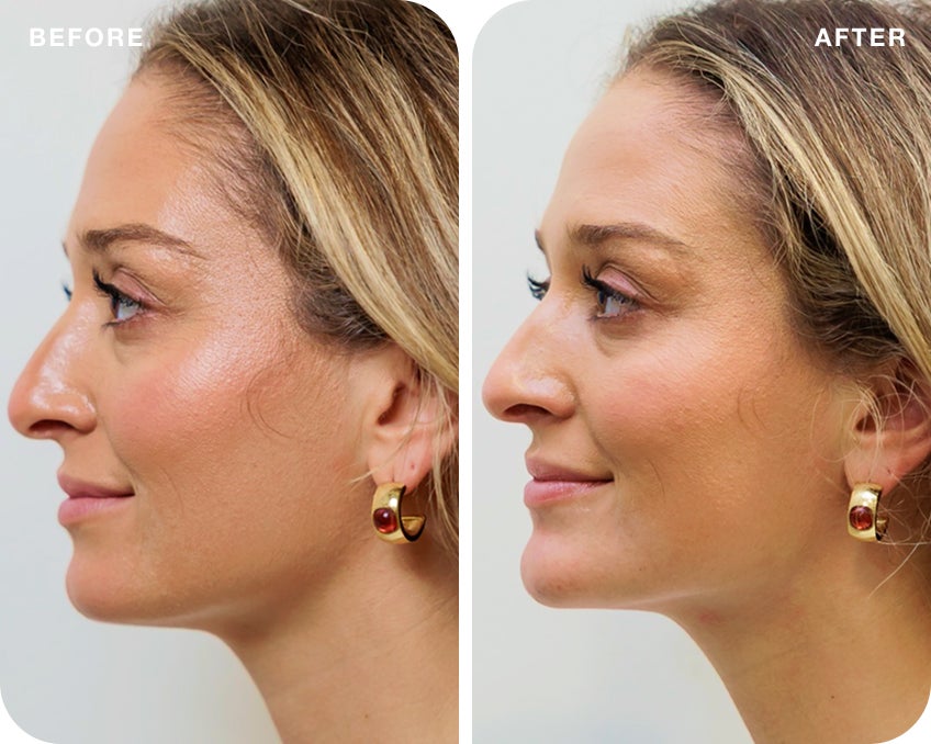 A before and after side profile of a woman after receiving filler treatment