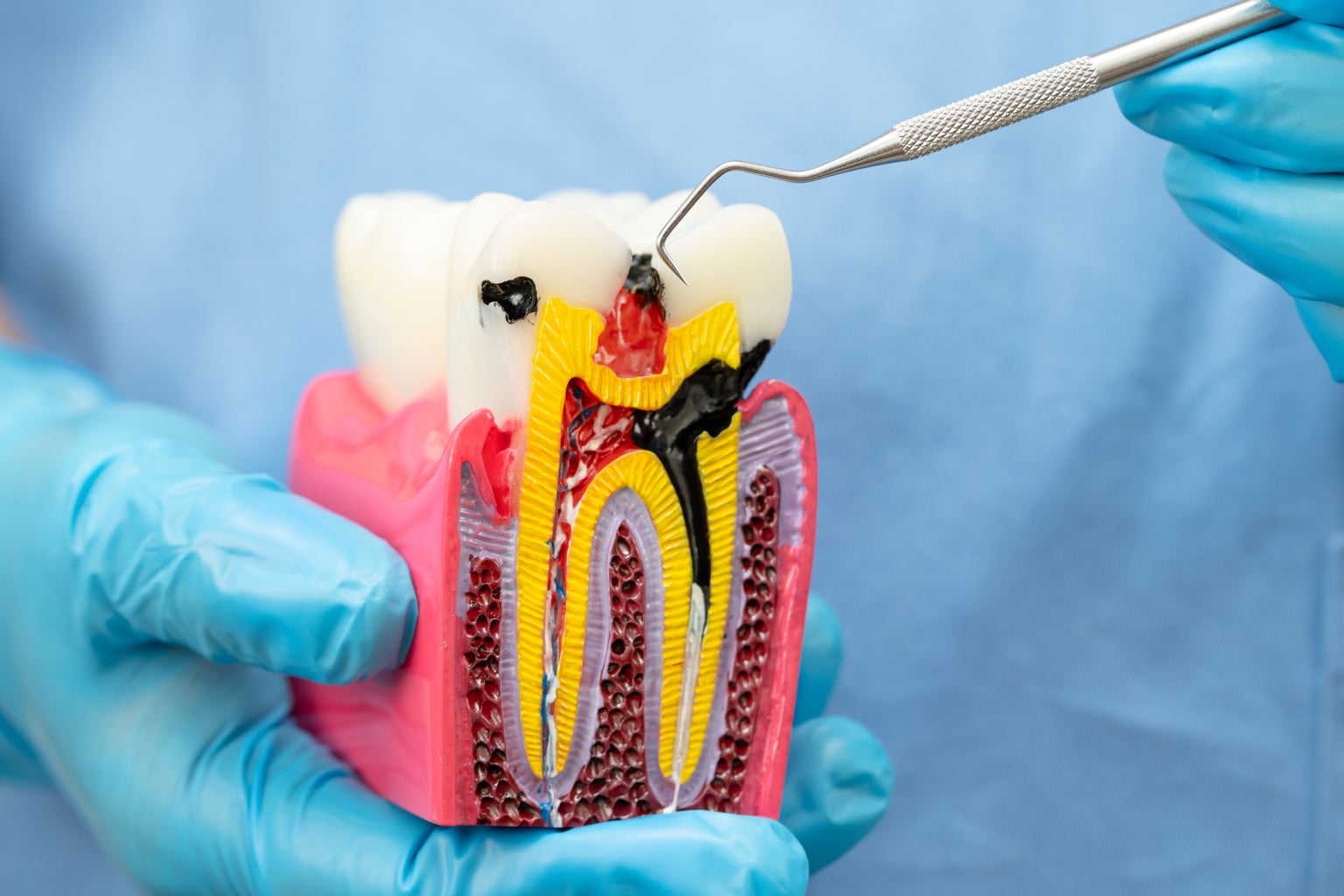 Tooth Decay