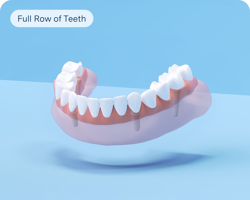 Lower arch model of implant-supported denture secured by four titanium posts for stable, natural-feeling tooth restoration.