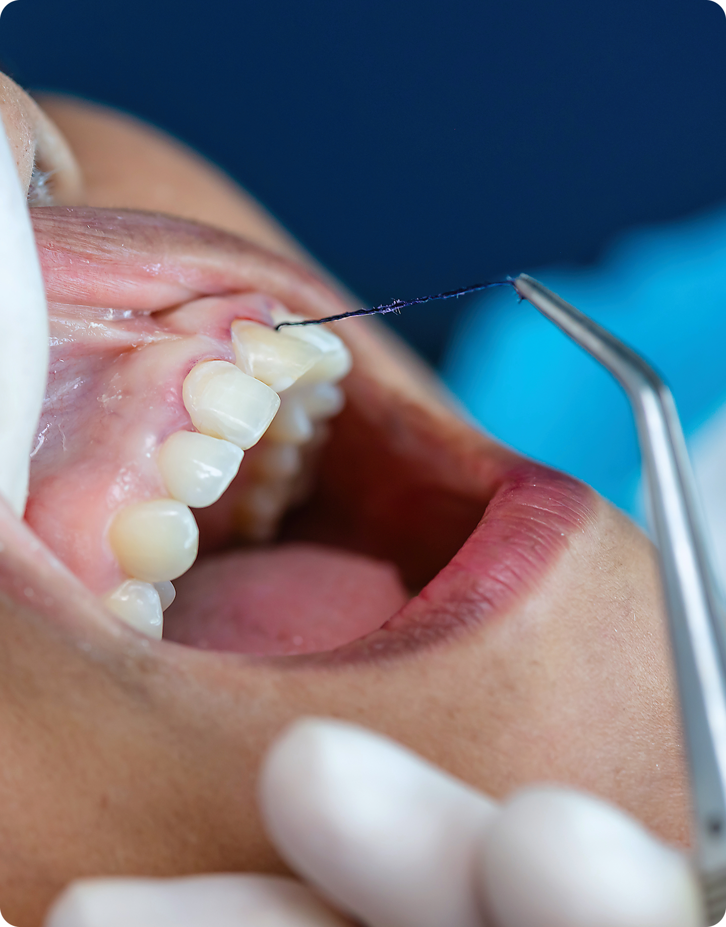 Periodontal surgery procedure