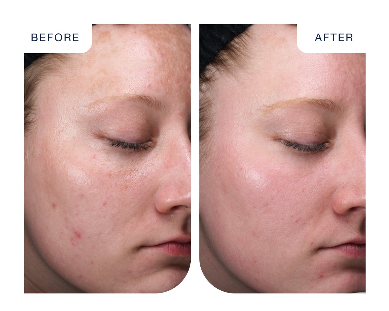 Before and after results of a VI Peel treatment at Chapter, showing clearer skin with reduced blemishes and smoother texture.