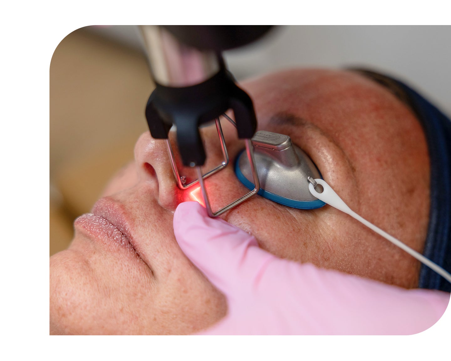 Facial laser treatment with protective eyewear