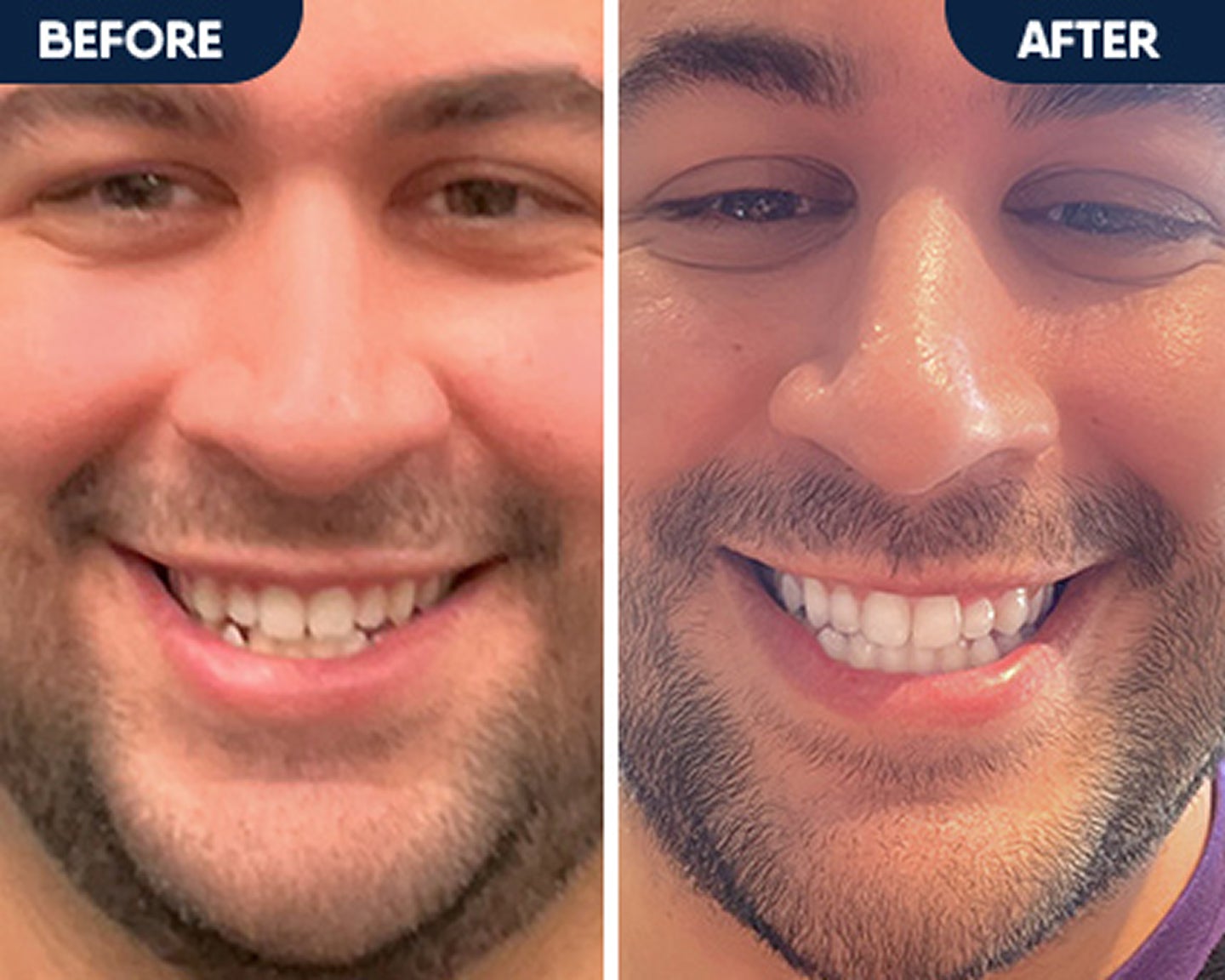 Before and after smile showing improved teeth alignment and smile results from clear aligner treatment with Motto