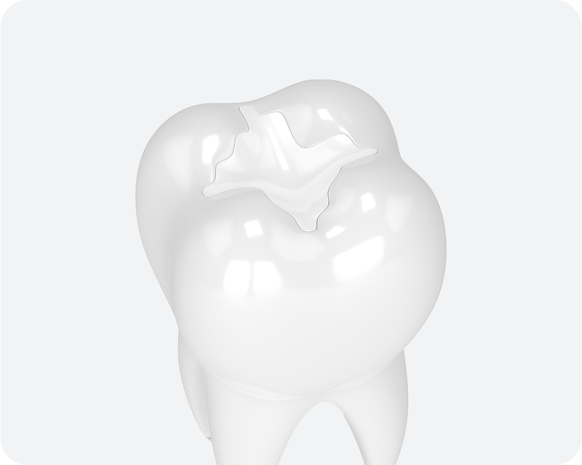 A 3D illustration of a white molar tooth with a tooth-colored or composite filling visible on the biting surface.
