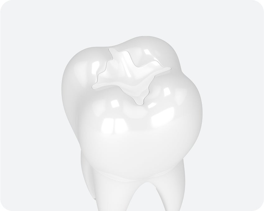 A 3D illustration of a white molar tooth with a tooth-colored or composite filling visible on the biting surface.