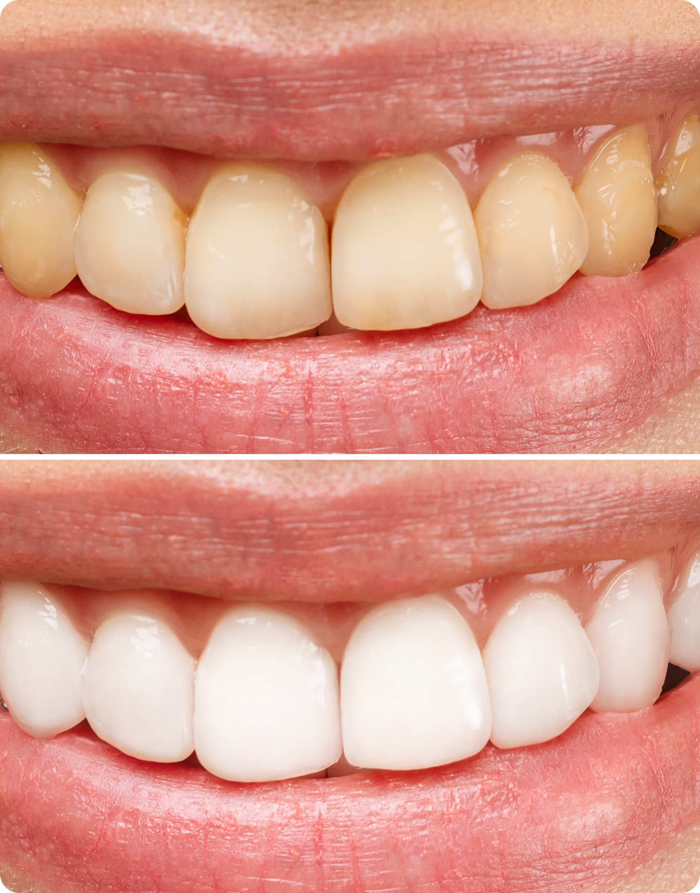 How to whiten your teeth