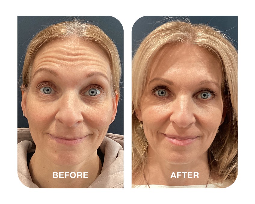 Before and after showing significant smoothing of forehead wrinkles