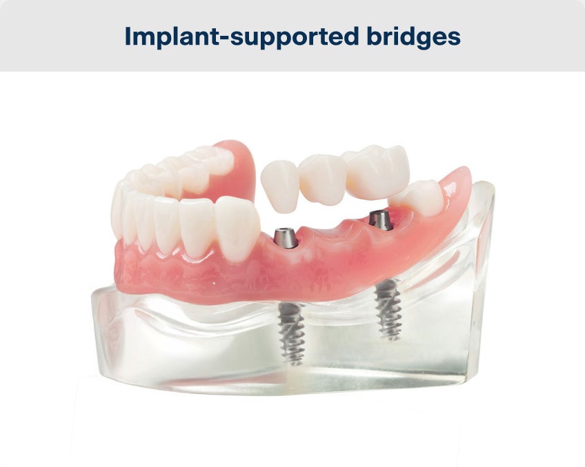 A realistic model of a lower dental arch, with a dental bridge attached to the gums through implants, supporting the middle tooth through implants on the two neighboring teeth.