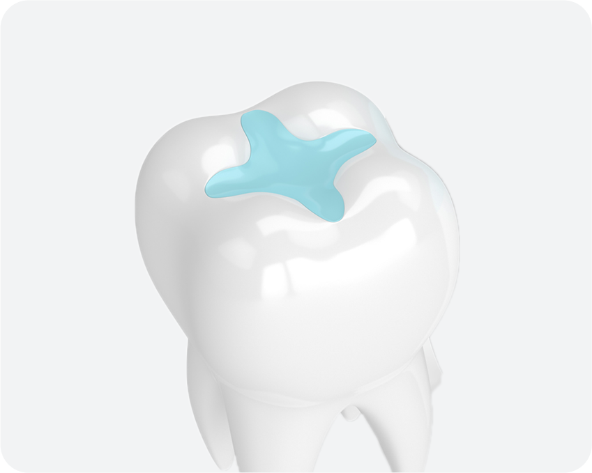 A 3D illustration of a white molar tooth with a light blue or cyan-colored glass ionomer filling visible on the biting surface.