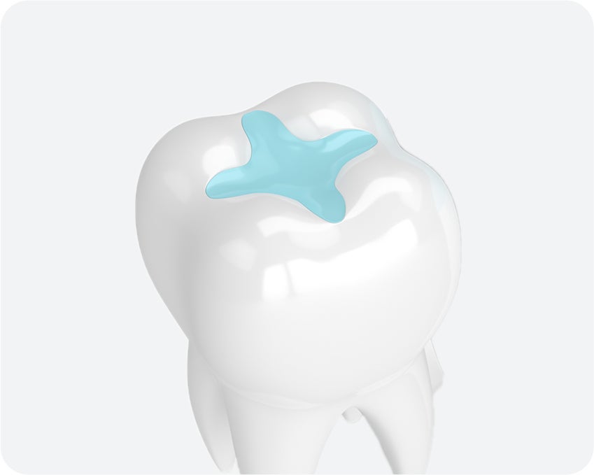 A 3D illustration of a white molar tooth with a light blue or cyan-colored glass ionomer filling visible on the biting surface.