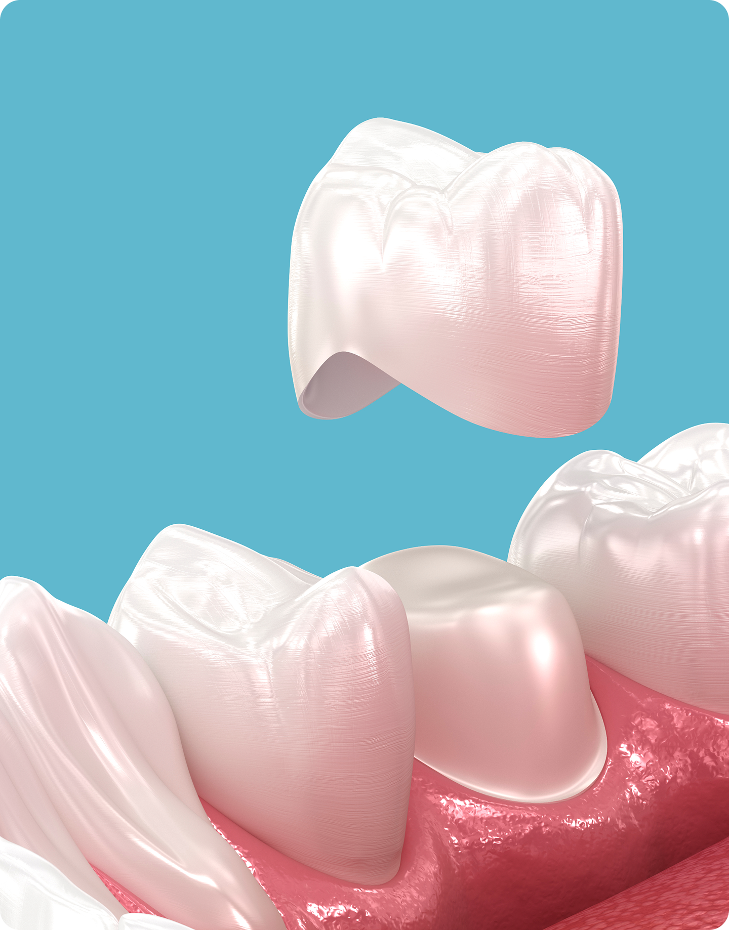 3D illustration of a porcelain dental crown positioned above a prepared tooth, showing how a crown fits over the tooth.