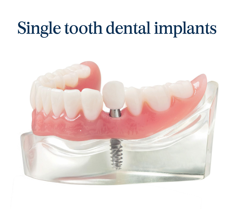 Single tooth dental implants. Model showing a single dental implant with a titanium post and crown replacing one missing tooth.