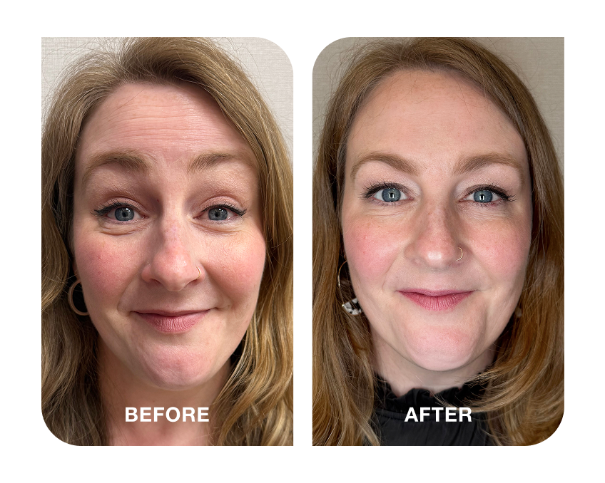 Before and after comparison of a woman's face showing visibly improved skin appearance