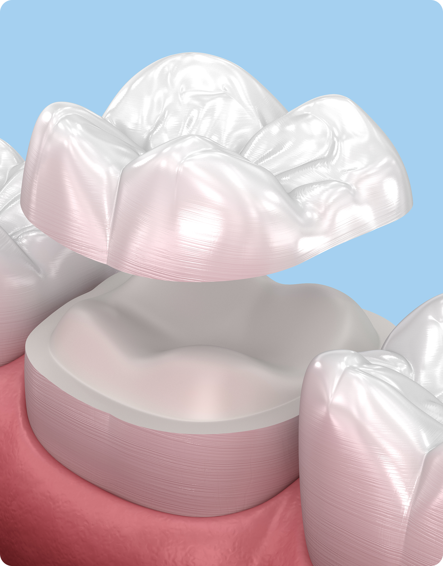 Ceramic crown for tooth