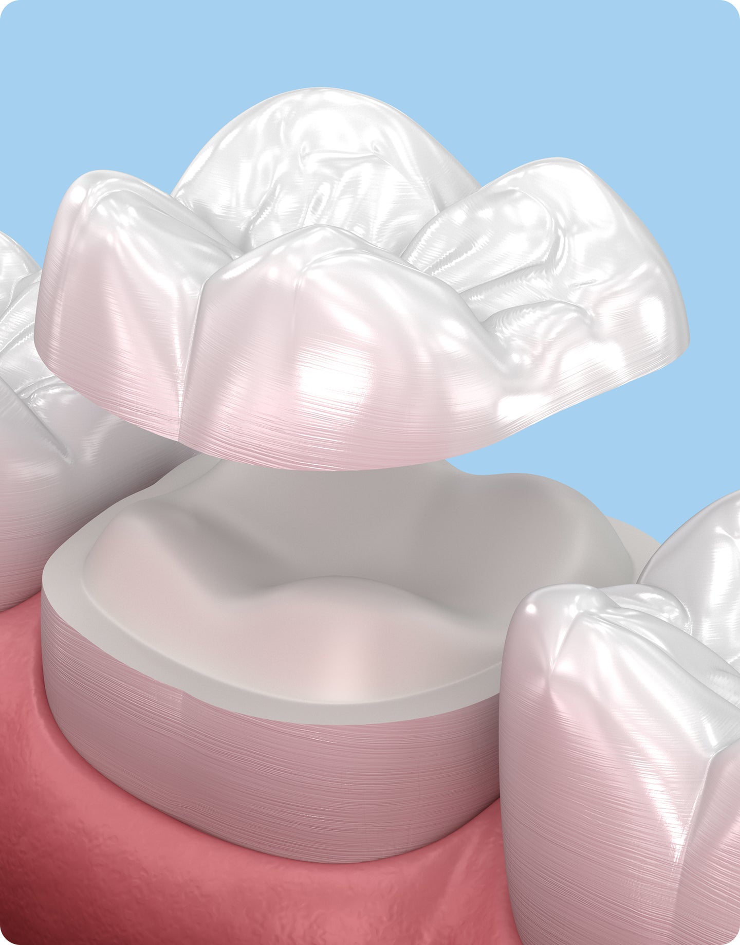 Ceramic crown for tooth