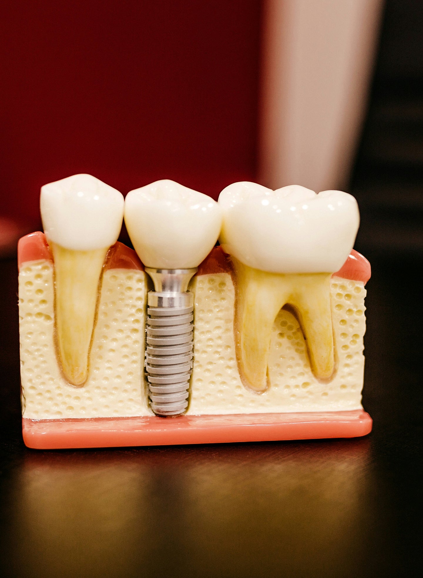 Dental implant abutments: what they are, the types, and what to expect