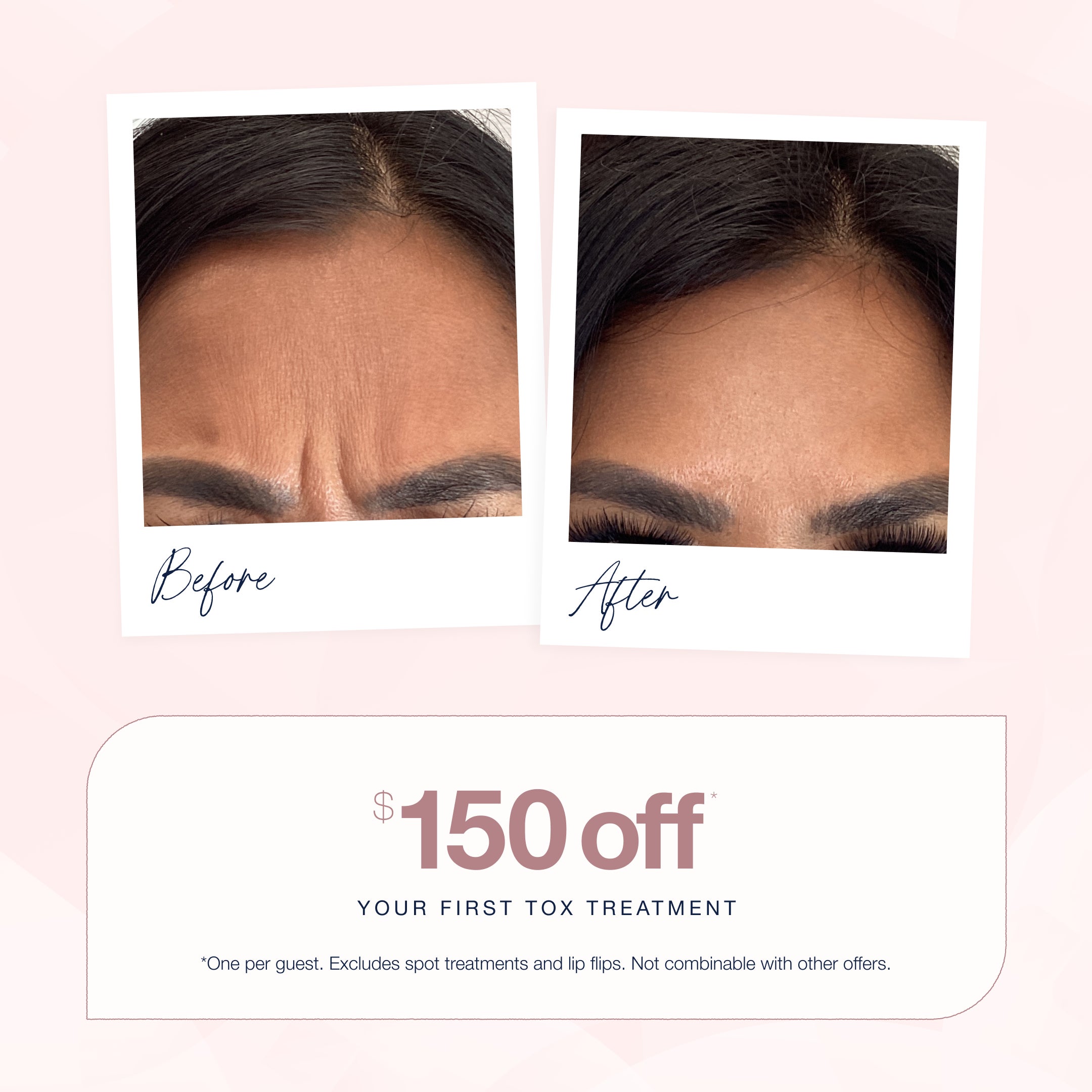 Two side by side "Before and After" images showing reduced forehead lines after Botox treatment, placed above a promotional graphic which reads "$150 off your first Tox treatment - *One per guest. Excludes spot treatments and lip flips. Not combinable with other offers."

