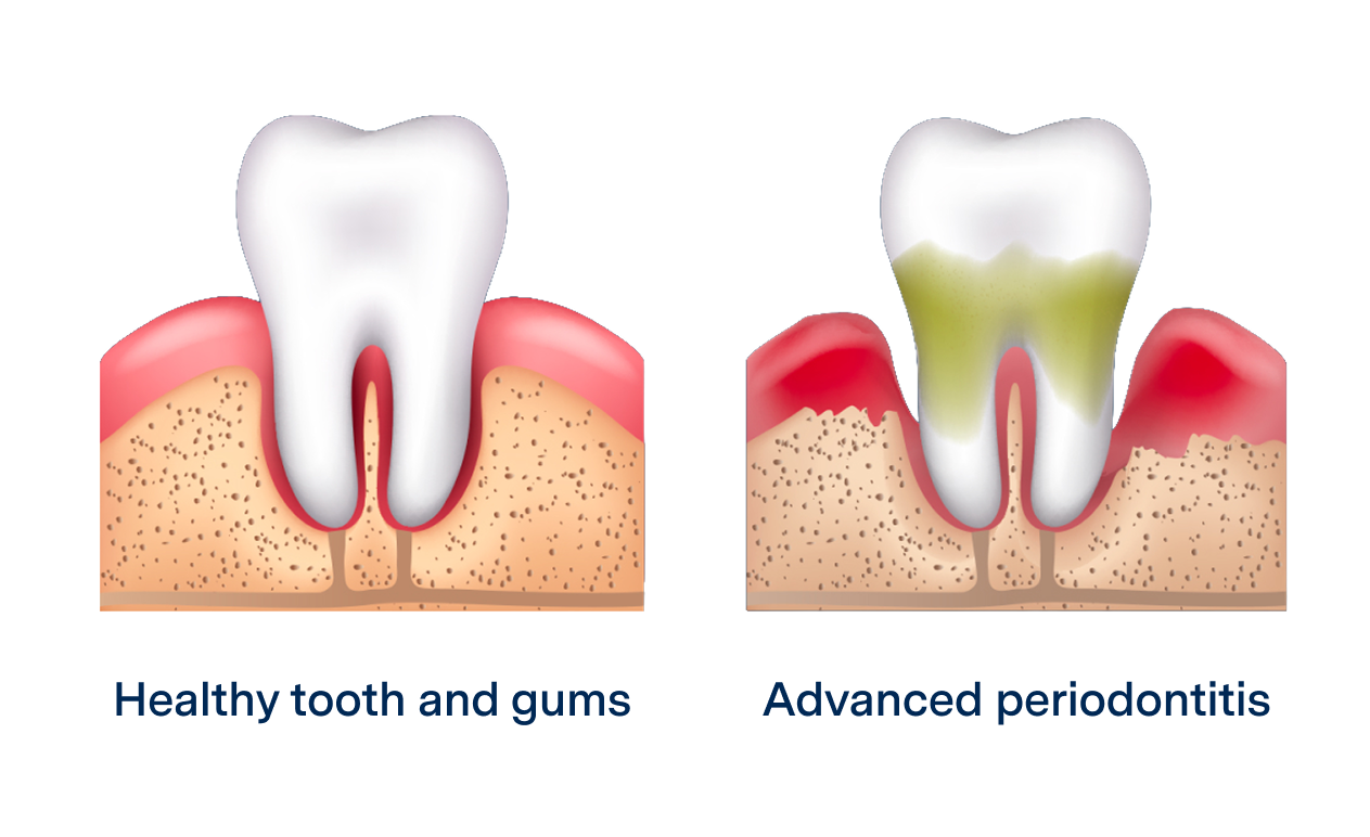 A side-by-side illustration comparing a healthy tooth and gums with advanced periodontitis, showing gum inflammation, plaque buildup, and bone loss in advanced gum disease.