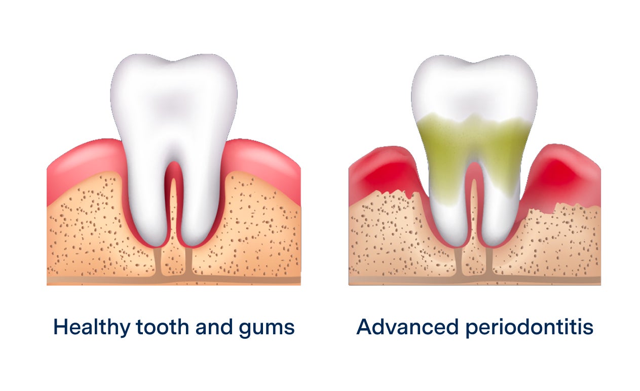 A side-by-side illustration comparing a healthy tooth and gums with advanced periodontitis, showing gum inflammation, plaque buildup, and bone loss in advanced gum disease.