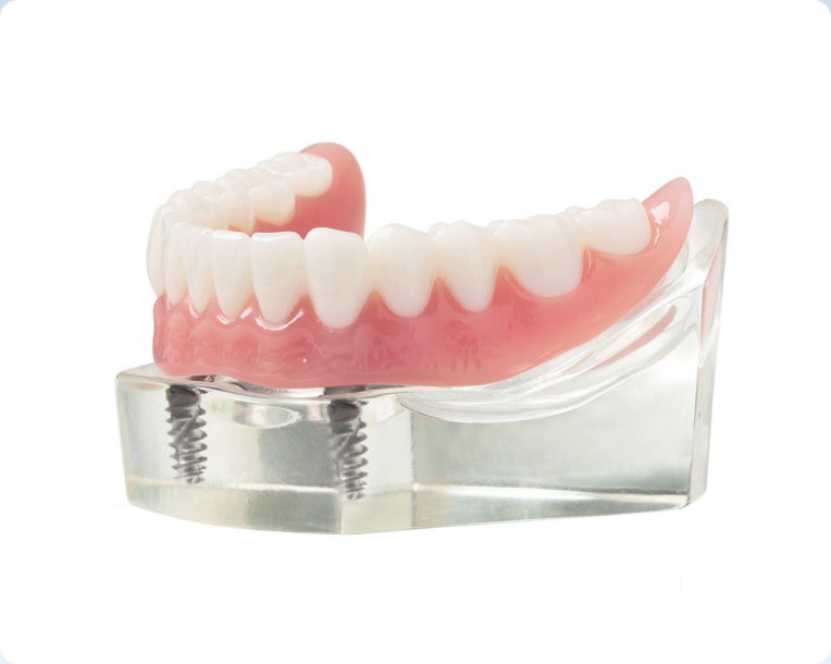 A lower arch teeth model with a full-arch dental implant anchored with titanium implants.