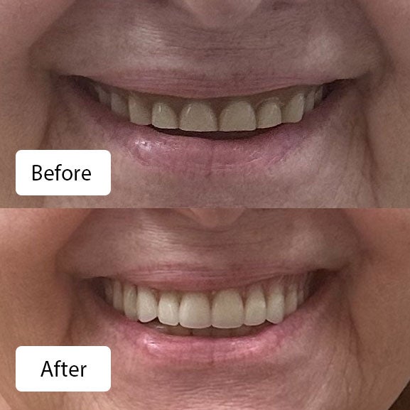 Pat Rowland before (top) and after (bottom) Signature dentures at Aspen Dental in Smyrna, TN.