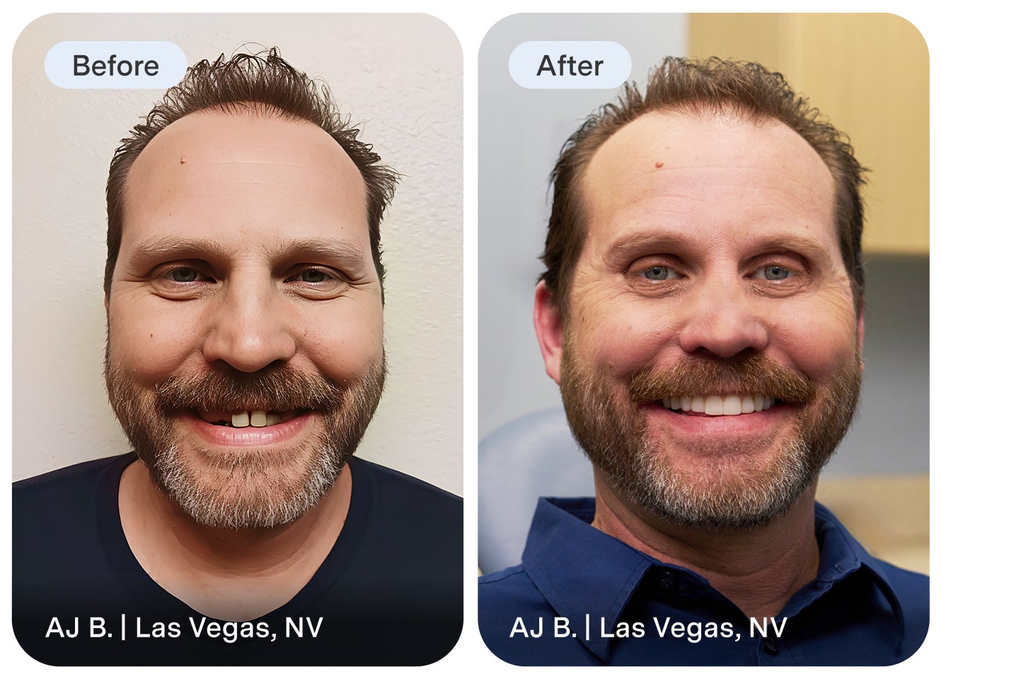Side-by-side before-and-after photos of a male dental patient showing a noticeable improvement in his smile. The before image shows worn or missing teeth, and the after image shows a brighter, fuller smile.