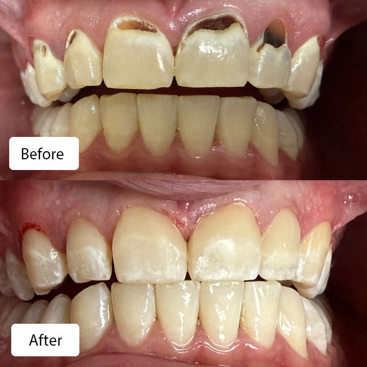 (Top) Before image showing tooth decay (Bottom) After treatment taking care of the tooth decay