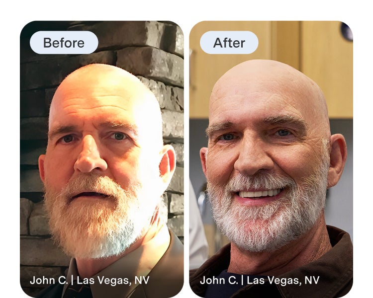 An Aspen Dental implant dentures patient highlights their before image and reveals their new smile after treatment.