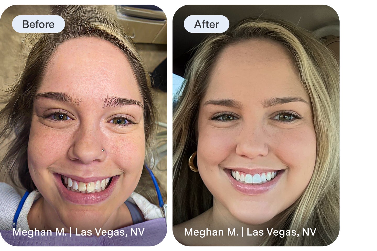 Side-by-side before and after photos of a smiling woman showing a bright, even smile transformation after receiving dental veneers.
