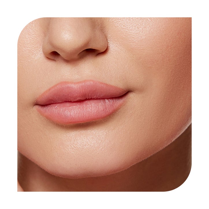 Dermal filler treatment results in Fargo, North Dakota