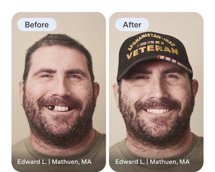 An Aspen Dental implant dentures patient highlights their before image and reveals their new smile after treatment.