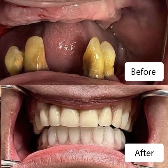 before his full mouth extraction and upper/lower same day All- On -4 dental restoration, at Aspen Dental in Pembroke Pines, FL (top). After his full mouth extraction and upper/lower same day All- On -4 dental restoration, at Aspen Dental in Pembroke Pines, FL (bottom). 