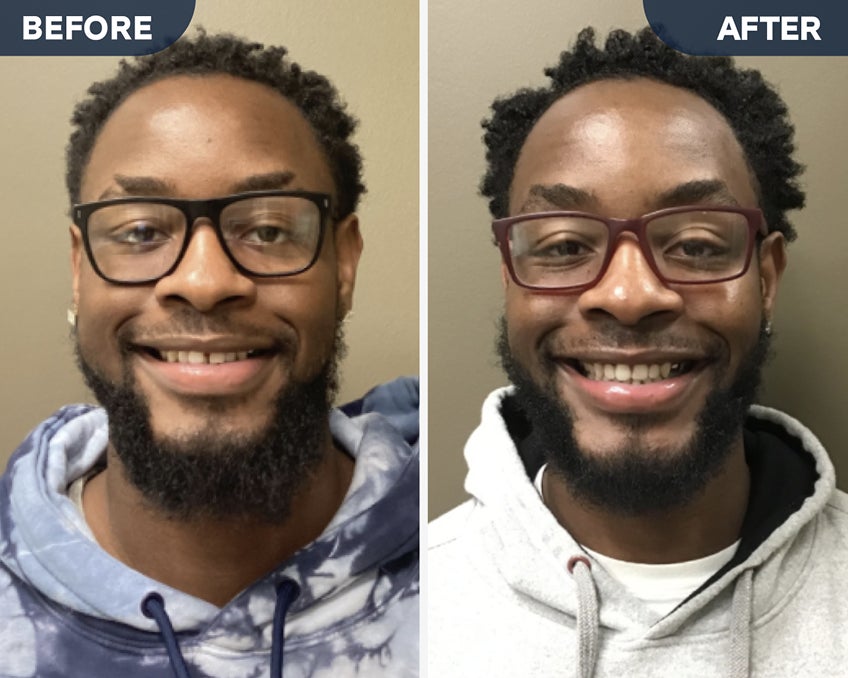 Before and after photos of a man's smile transformation, showing a closed tooth gap