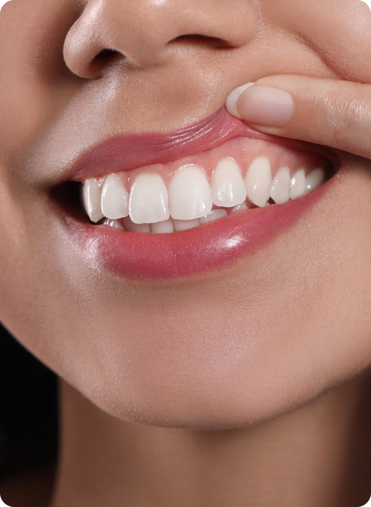 Close-up of a person lifting their lip to show healthy-looking gums and back teeth, suggesting concern about a loose gum flap behind a back tooth.
