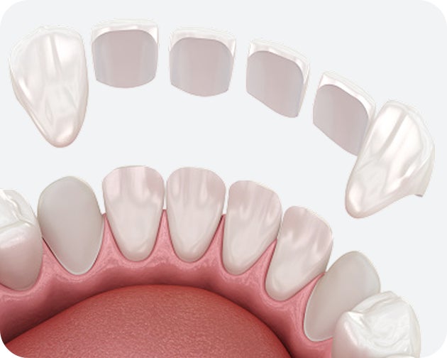A 3D illustration of removable snap-on veneers designed to fit over upper and lower teeth for an instant smile enhancement.
