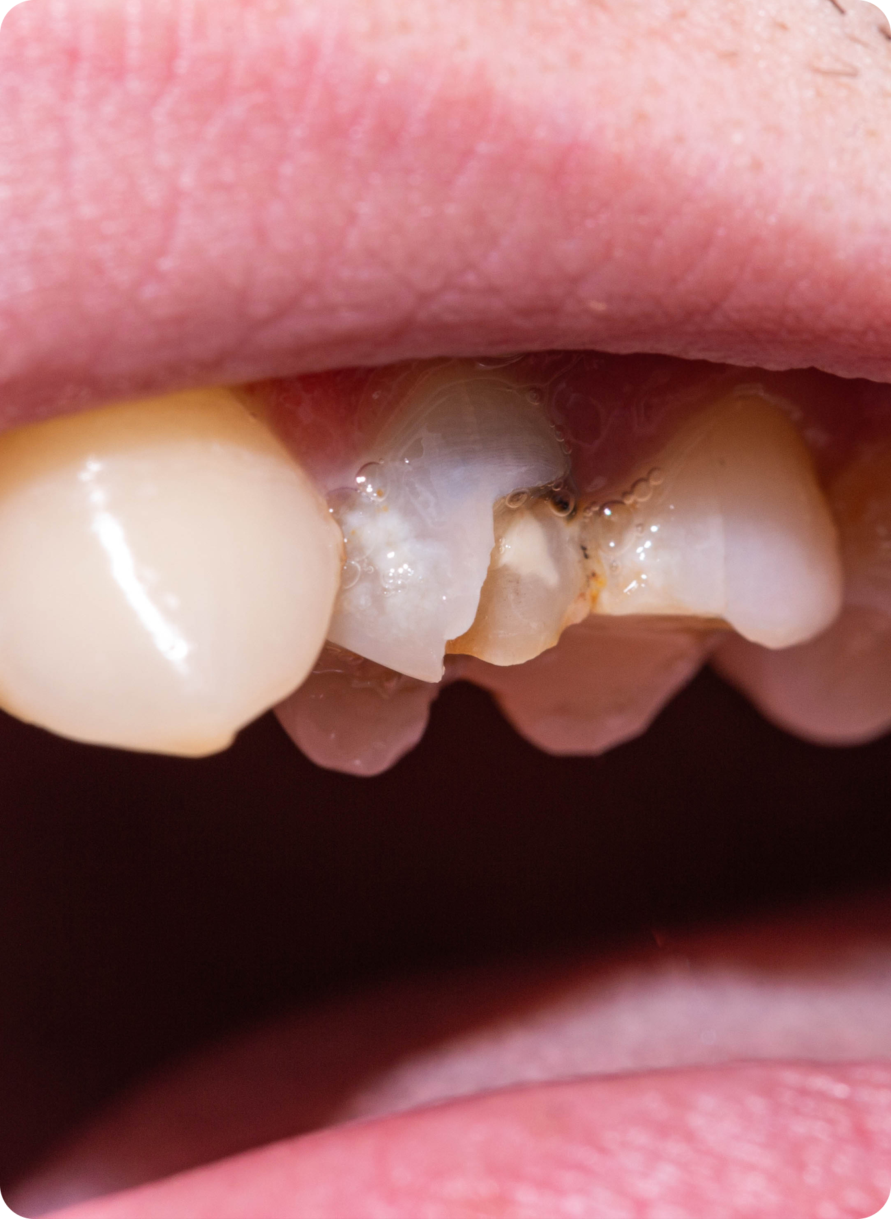 What to do if you have a chipped crown