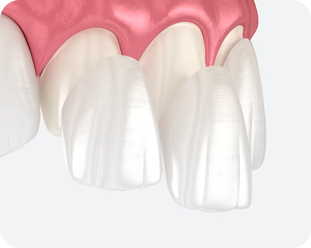 A 3D illustration showing thin porcelain laminate veneers being placed over teeth to improve color and shape with minimal enamel removal.