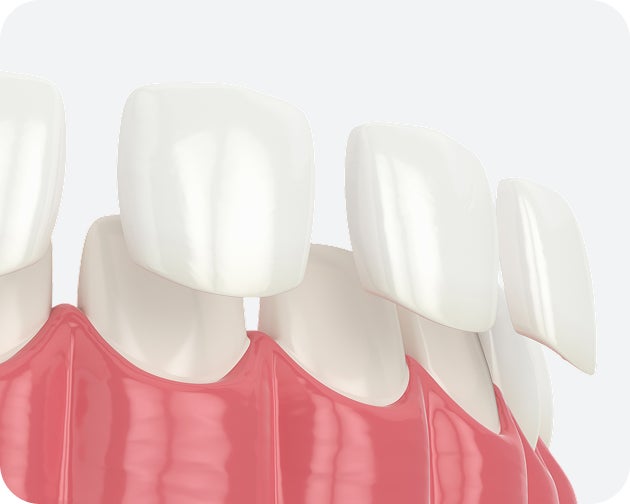 A 3D illustration showing porcelain veneers being applied to front teeth for a natural-looking smile transformation.