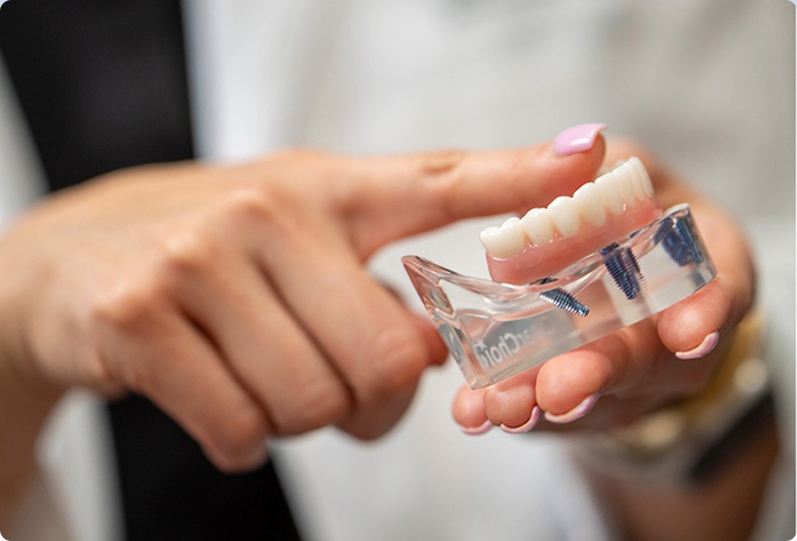 A ClearChoice doctor holding a model of lower arch dental implants.