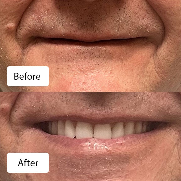 Jack Whitt before (top) and after (bottom) Signature Elite dentures at Aspen Dental in Smyrna, TN