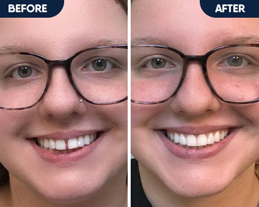 Before and after smile showing improved teeth alignment and confidence from clear aligner treatment with Motto