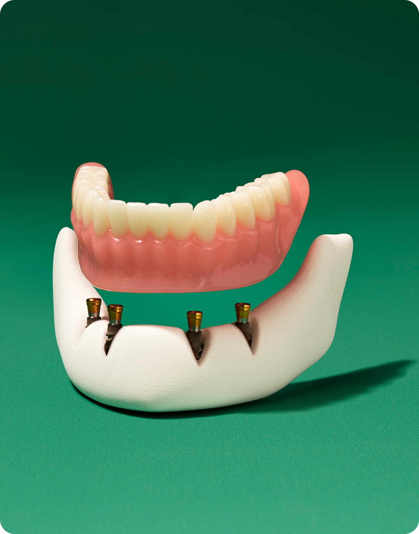 Dental implants at Aspen Dental in Clearwater, FL