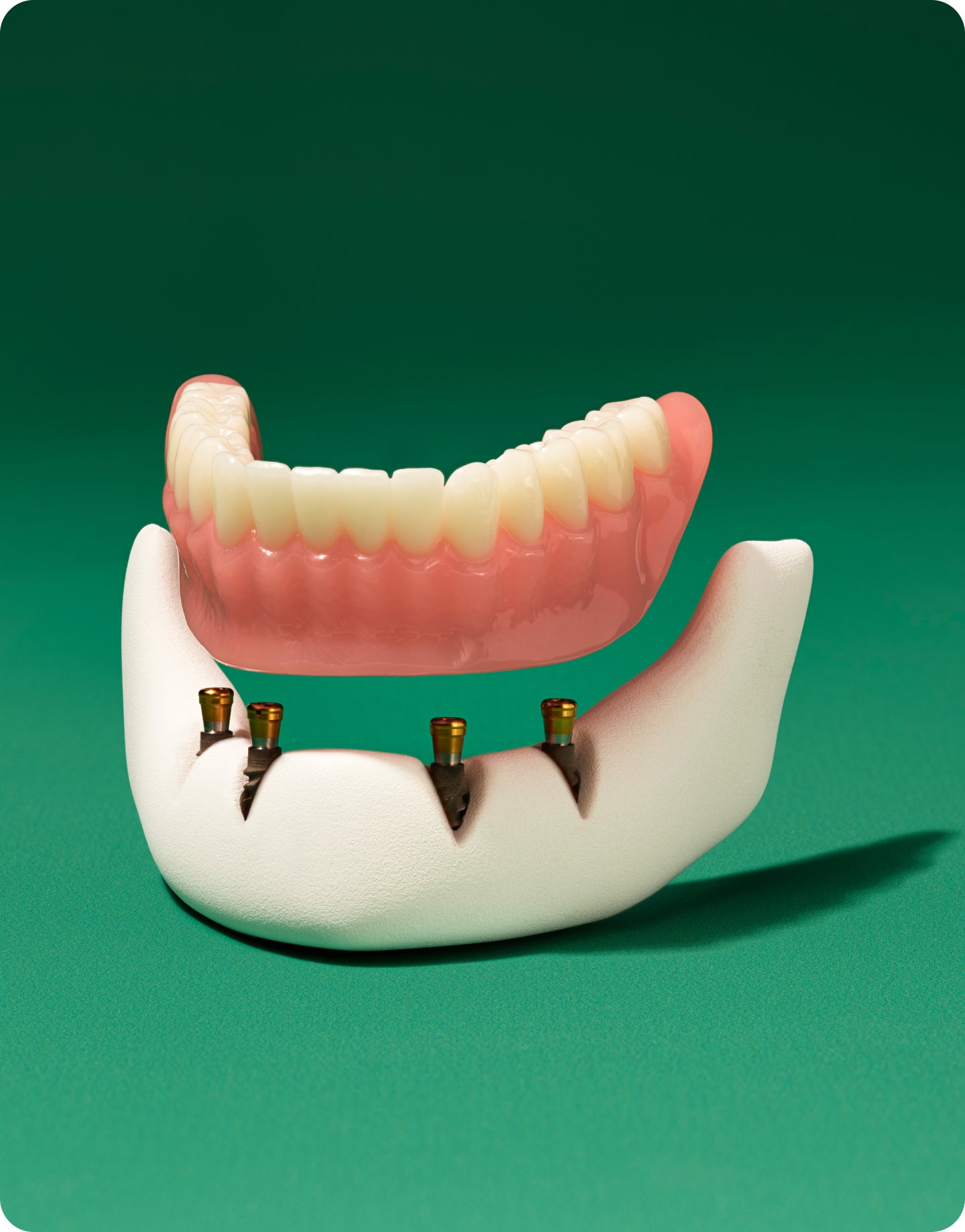 Dental implants at Aspen Dental in Clearwater, FL