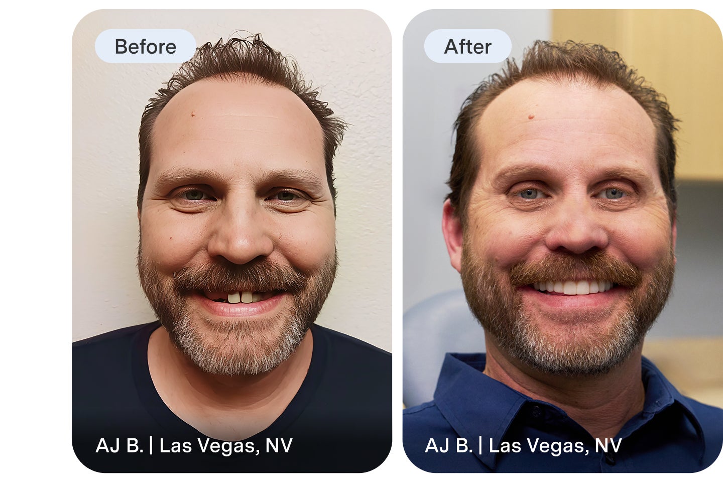 An Aspen Dental dentures patient highlights their before image and reveals their new smile after treatment.