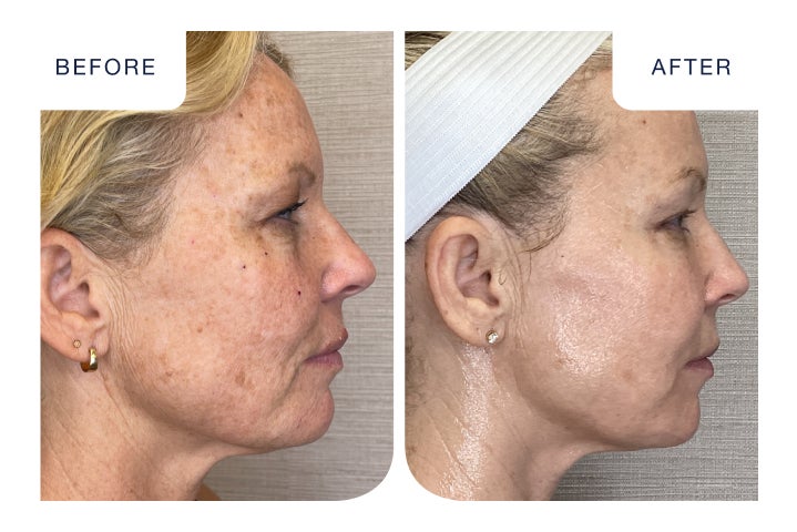 Before and after comparison showing improved skin tone, reduced hyperpigmentation, and a more defined jawline after receiving CoolPeel treatment at Chapter Aesthetic Studio