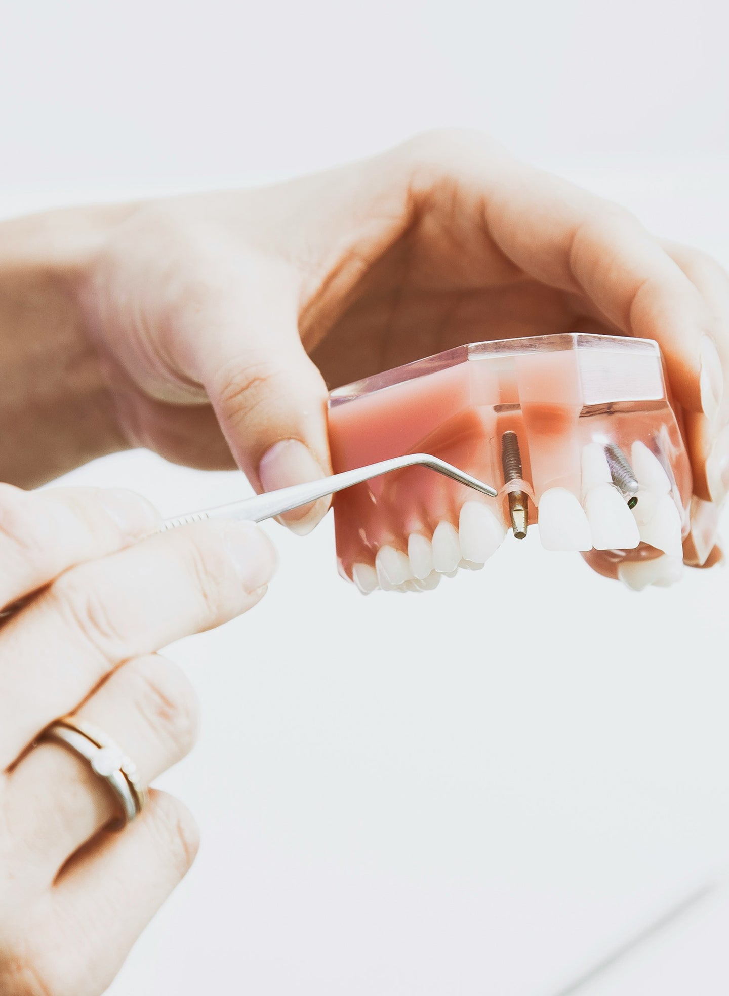 Denture repair: what to do when dentures crack, chip, or break