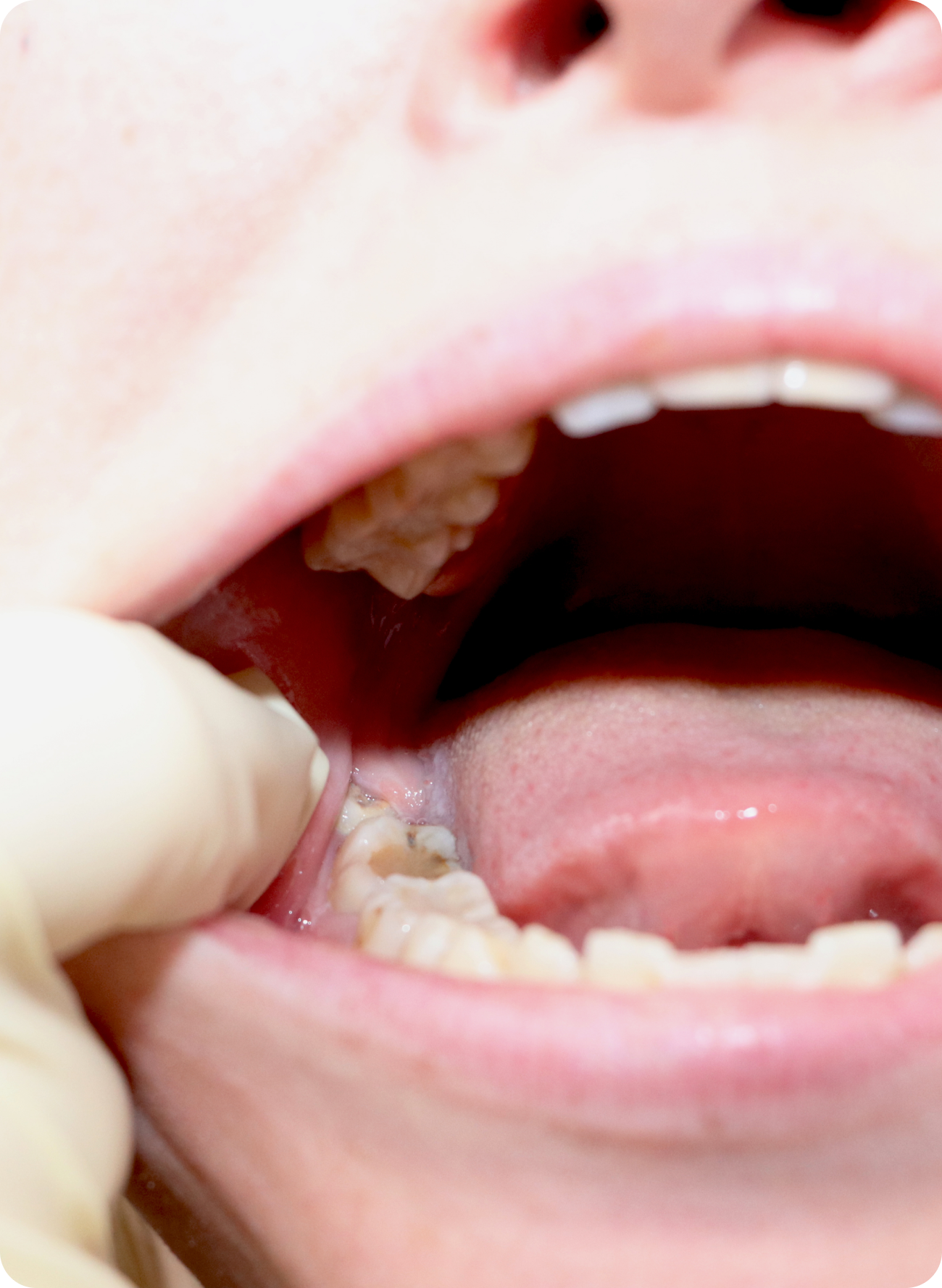 Molar tooth extraction